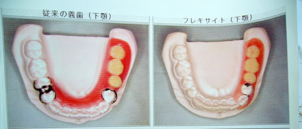 フレキサイト入れ歯（保険適応外）/3～4万円